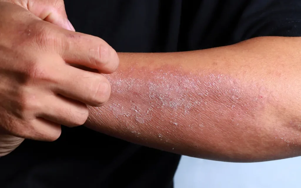 Skin Irritation After Wearing Washed Clothes?
